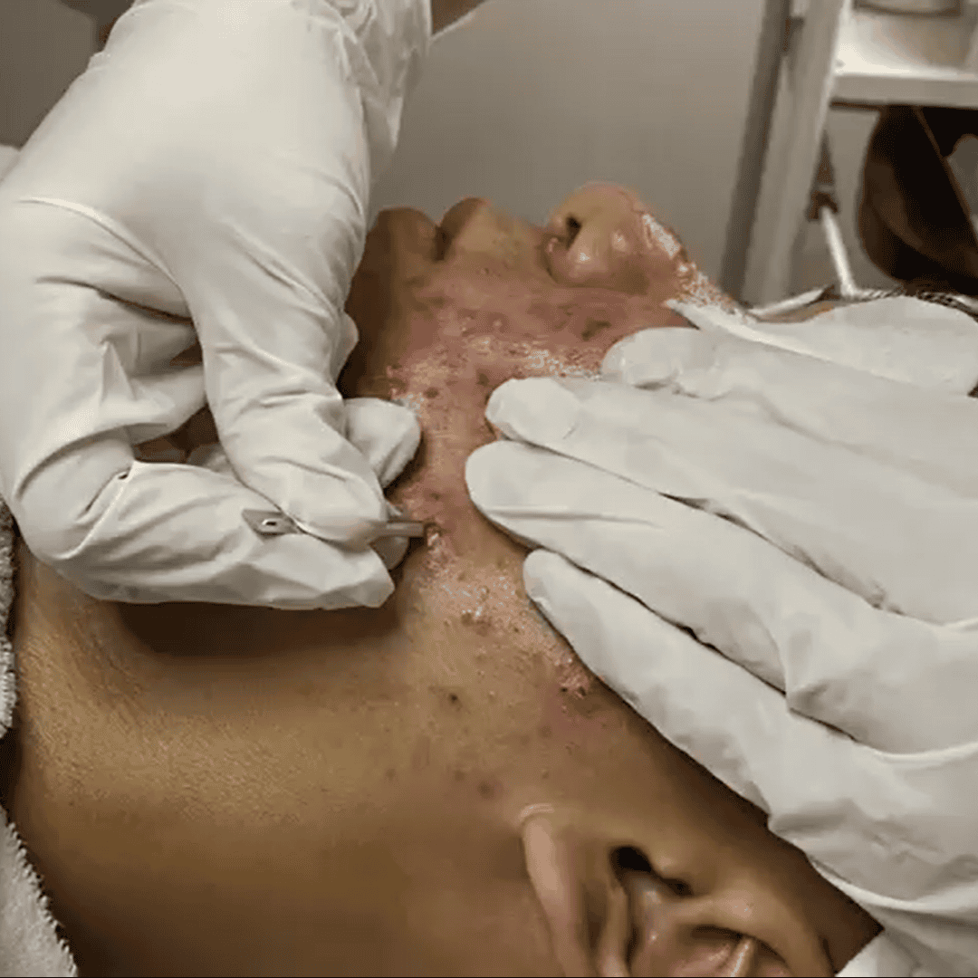 Trị mụn viêm không kháng sinh, không sưng đỏ, không sẹo thâm